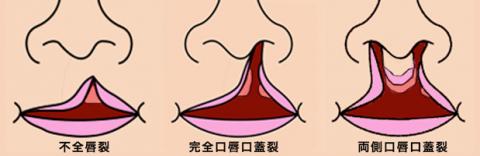 口唇口蓋裂は先天性異常の一種（日本では500人に1人が発症）