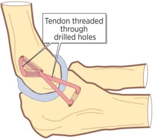体の別の場所（足・お尻など）から正常な靱帯を肘に移植する手術