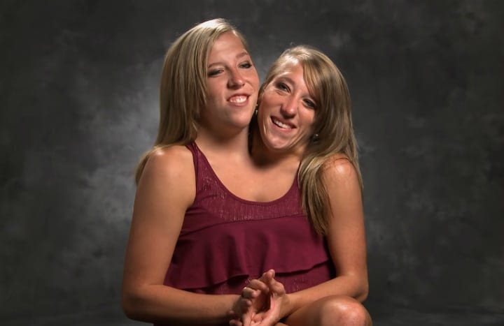 The Life of Abby & Brittany Hensel — Conjoined Twins – The Paper Cut