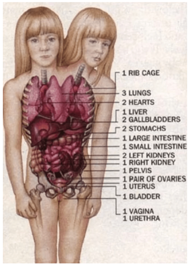 アビーとブリタニーの体の中を紹介している解剖分析図