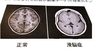 原因は滑脳症(かつのうしょう)